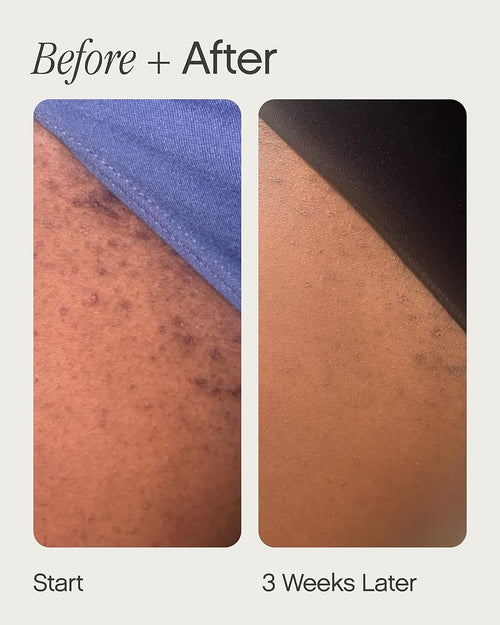 High Roller Ingrown Tonic With AHAs + BHAs